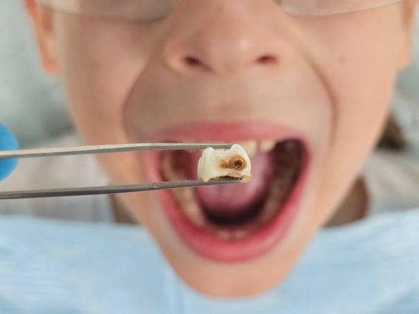 Best Emergency Tooth Extraction in Henderson, NV